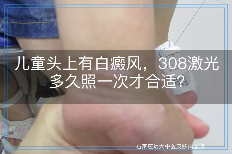 儿童头上有白癜风，308激光多久照一次才合适？