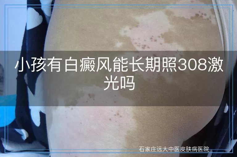 小孩有白癜风能长期照308激光吗