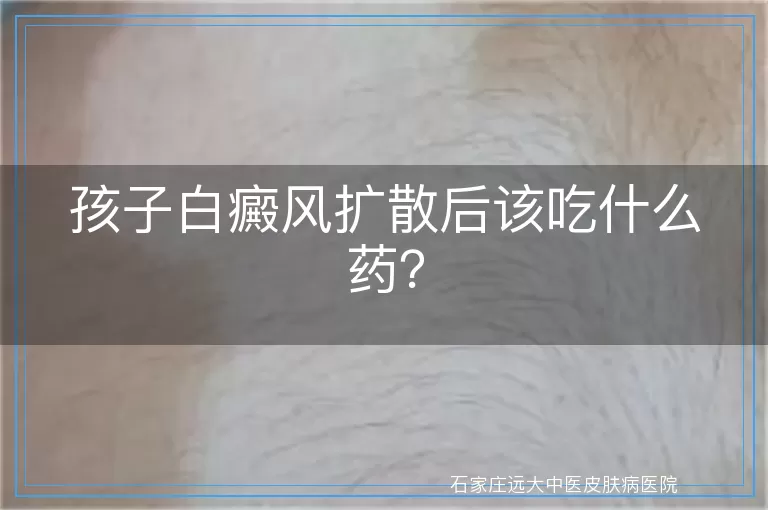 孩子白癜风扩散后该吃什么药？