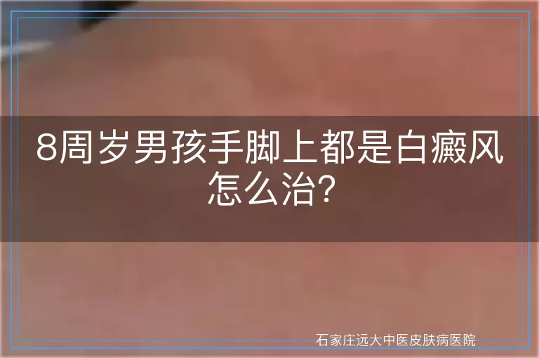 8周岁男孩手脚上都是白癜风怎么治？