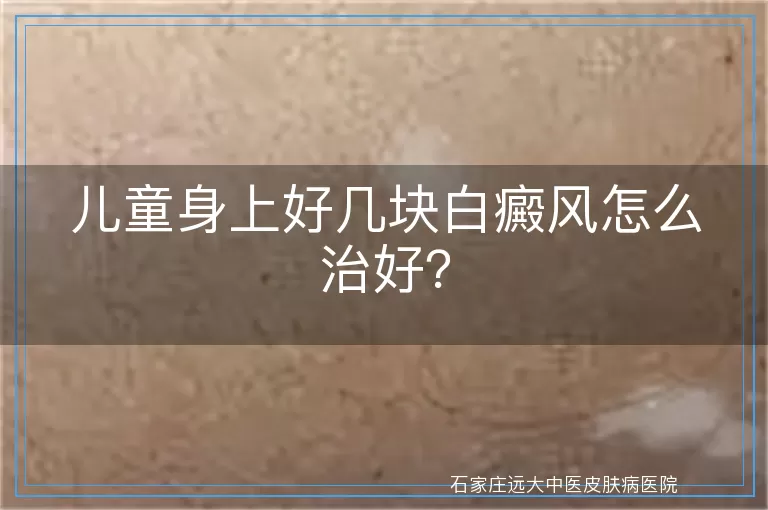 儿童身上好几块白癜风怎么治好？