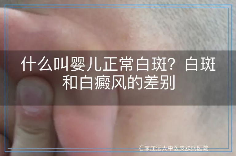 什么叫婴儿正常白斑？白斑和白癜风的差别