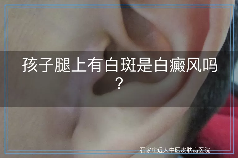 孩子腿上有白斑是白癜风吗？