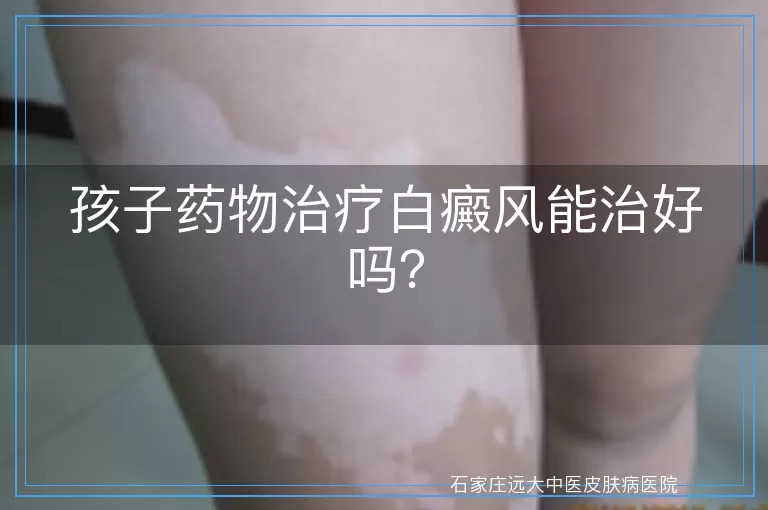 孩子药物治疗白癜风能治好吗？