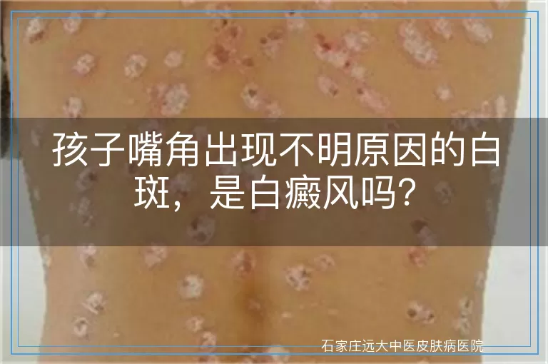 孩子嘴角出现不明原因的白斑，是白癜风吗？