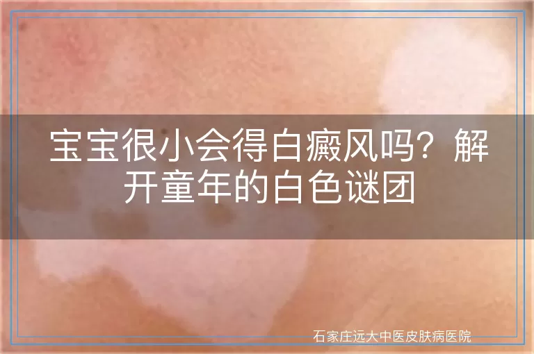 宝宝很小会得白癜风吗？解开童年的白色谜团