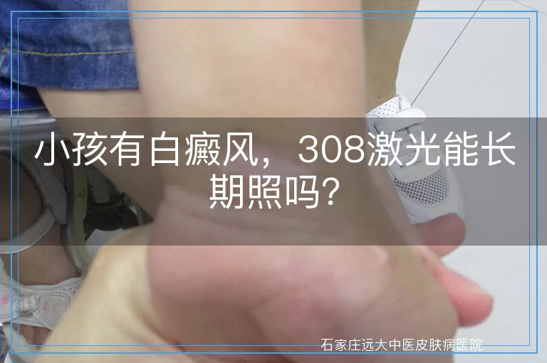 小孩有白癜风，308激光能长期照吗？