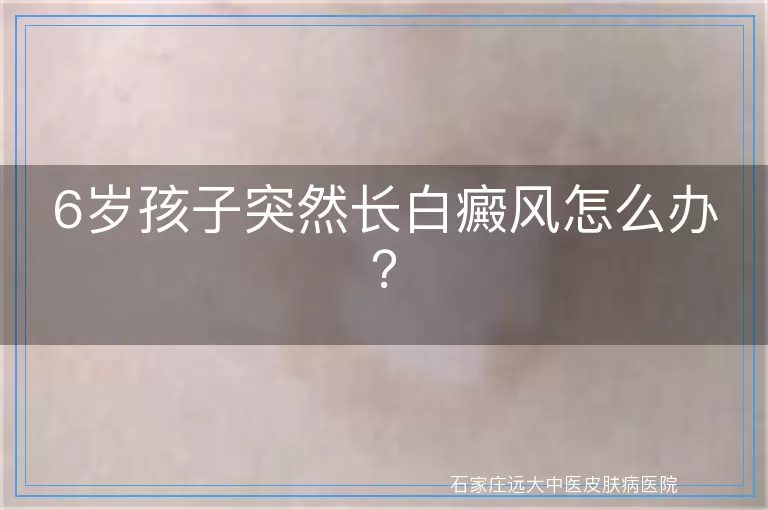 6岁孩子突然长白癜风怎么办？