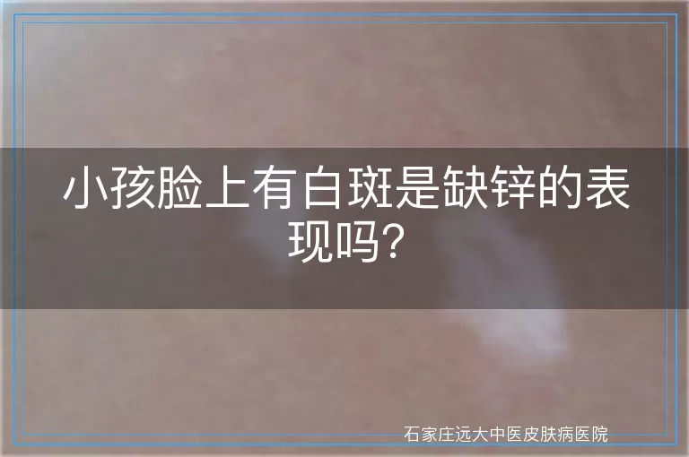 小孩脸上有白斑是缺锌的表现吗？