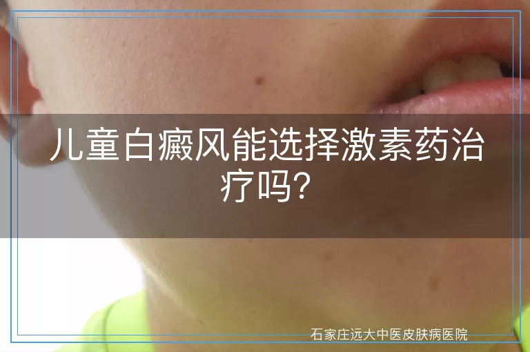 儿童白癜风能选择激素药治疗吗？