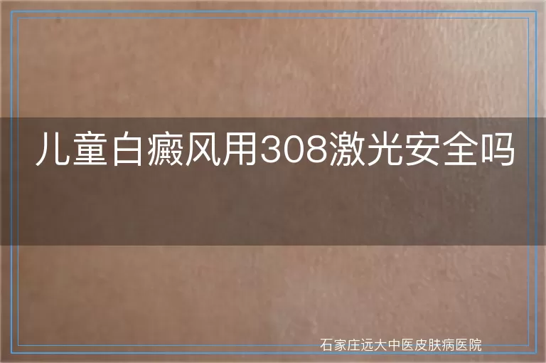 儿童白癜风用308激光安全吗