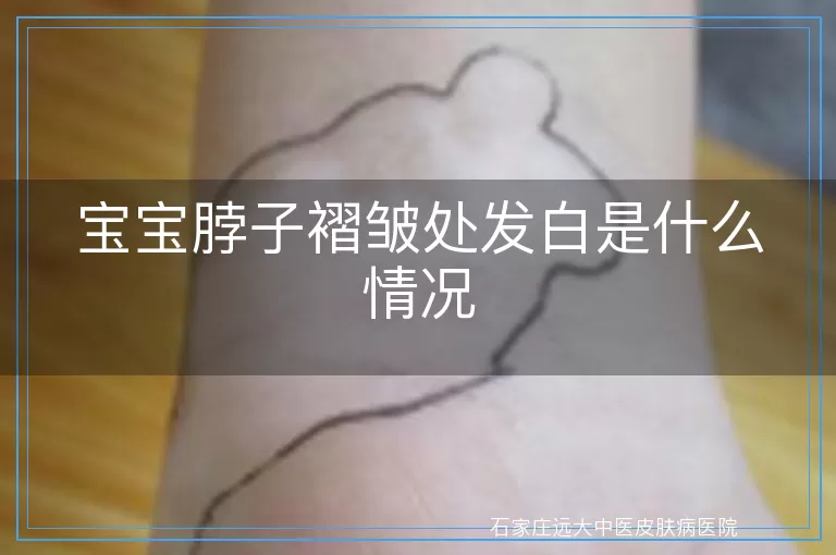 宝宝脖子褶皱处发白是什么情况