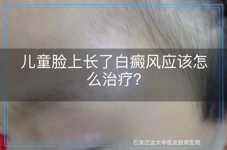 儿童脸上长了白癜风应该怎么治疗？