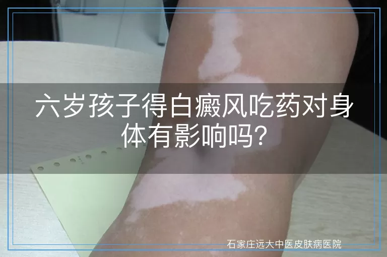 六岁孩子得白癜风吃药对身体有影响吗？