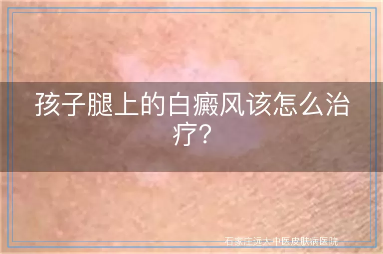 孩子腿上的白癜风该怎么治疗？