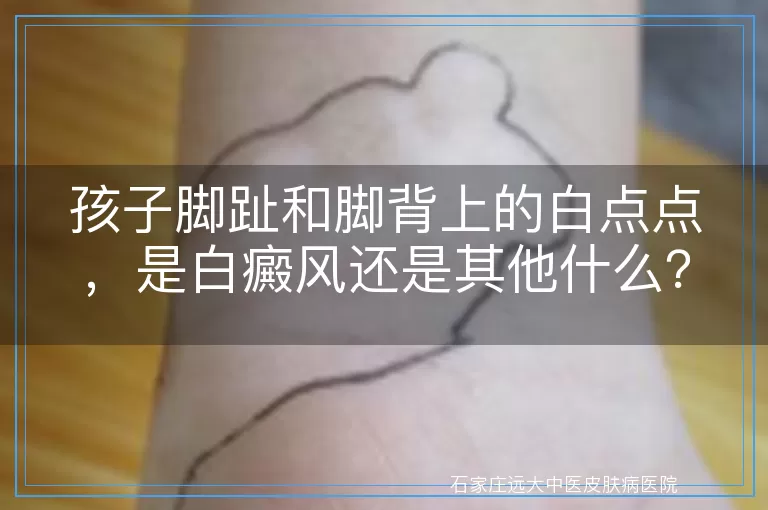 孩子脚趾和脚背上的白点点，是白癜风还是其他什么？