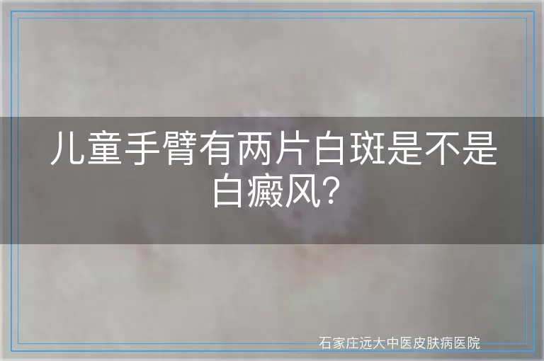 儿童手臂有两片白斑是不是白癜风？