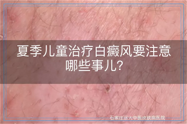 夏季儿童治疗白癜风要注意哪些事儿？