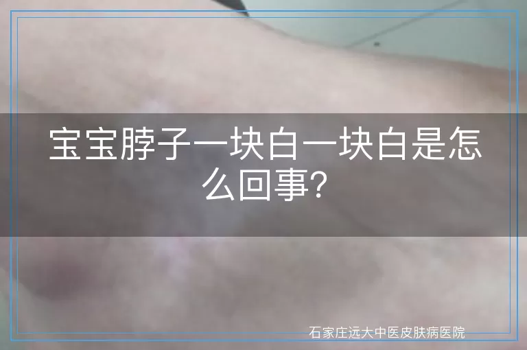 宝宝脖子一块白一块白是怎么回事？