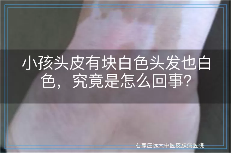 小孩头皮有块白色头发也白色，究竟是怎么回事？