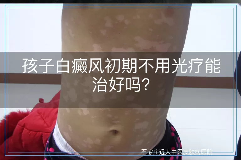 孩子白癜风初期不用光疗能治好吗？