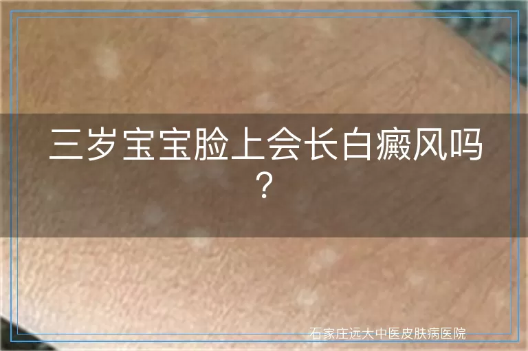 三岁宝宝脸上会长白癜风吗？