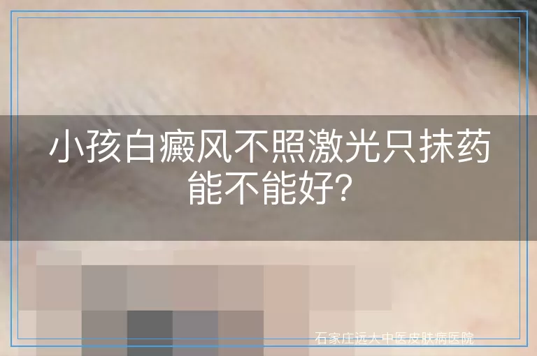 小孩白癜风不照激光只抹药能不能好？