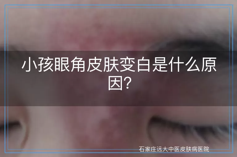 小孩眼角皮肤变白是什么原因？