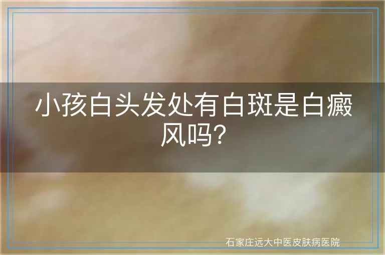 小孩白头发处有白斑是白癜风吗？