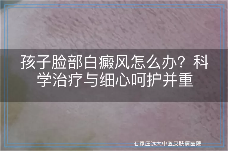 孩子脸部白癜风怎么办？科学治疗与细心呵护并重