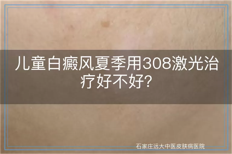 儿童白癜风夏季用308激光治疗好不好？