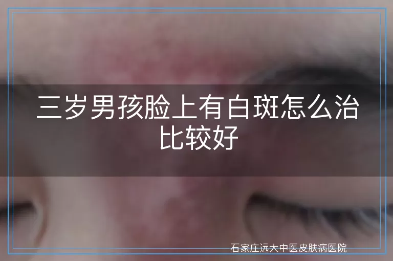 三岁男孩脸上有白斑怎么治比较好