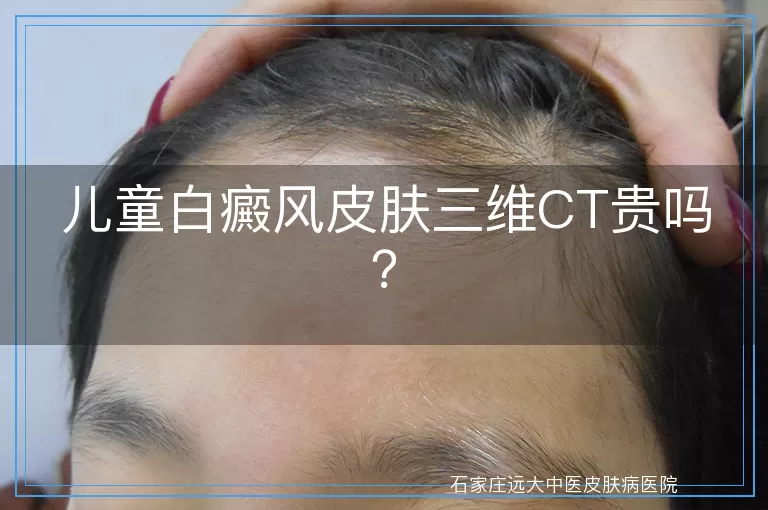 儿童白癜风皮肤三维CT贵吗？