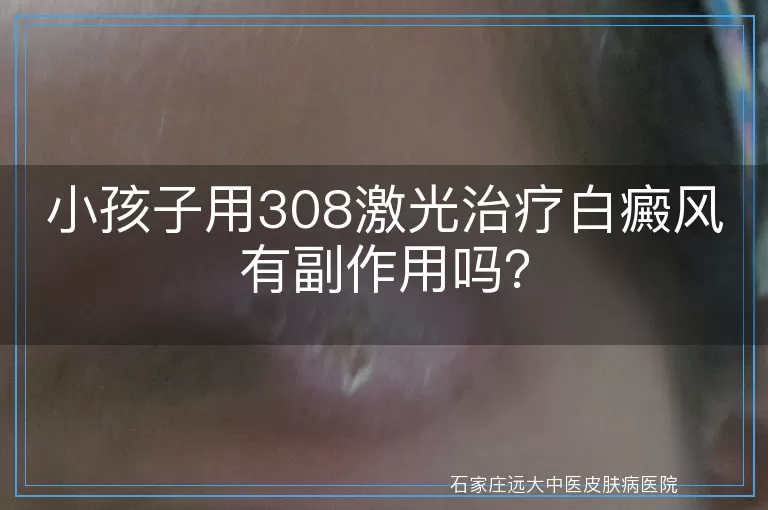 小孩子用308激光治疗白癜风有副作用吗？