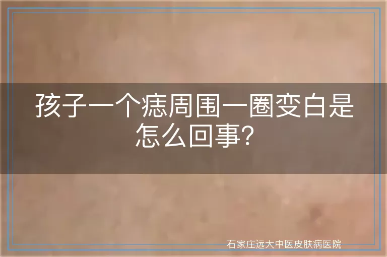 孩子一个痣周围一圈变白是怎么回事？