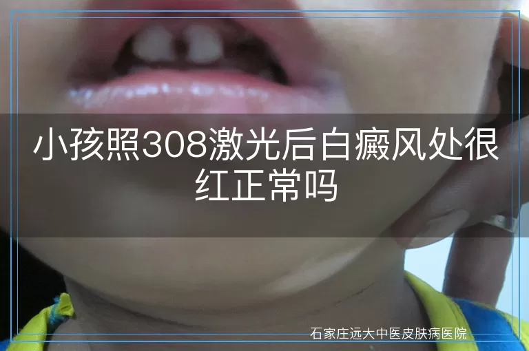 小孩照308激光后白癜风处很红正常吗