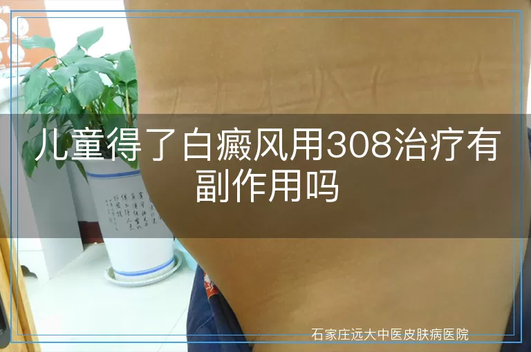 儿童得了白癜风用308治疗有副作用吗