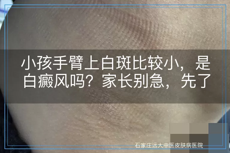 小孩手臂上白斑比较小，是白癜风吗？家长别急，先了解这些！