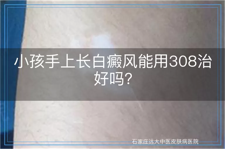 小孩手上长白癜风能用308治好吗？