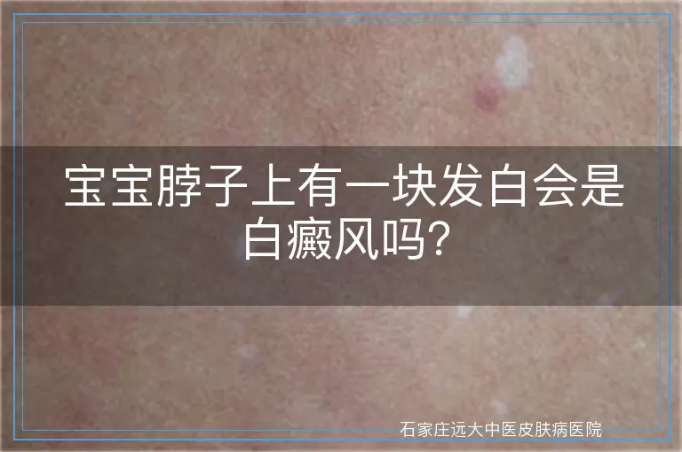 宝宝脖子上有一块发白会是白癜风吗？