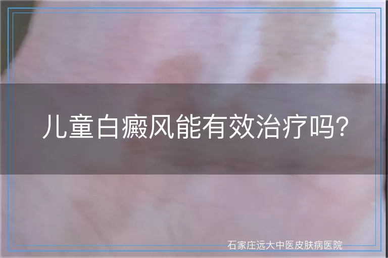 儿童白癜风能有效治疗吗？