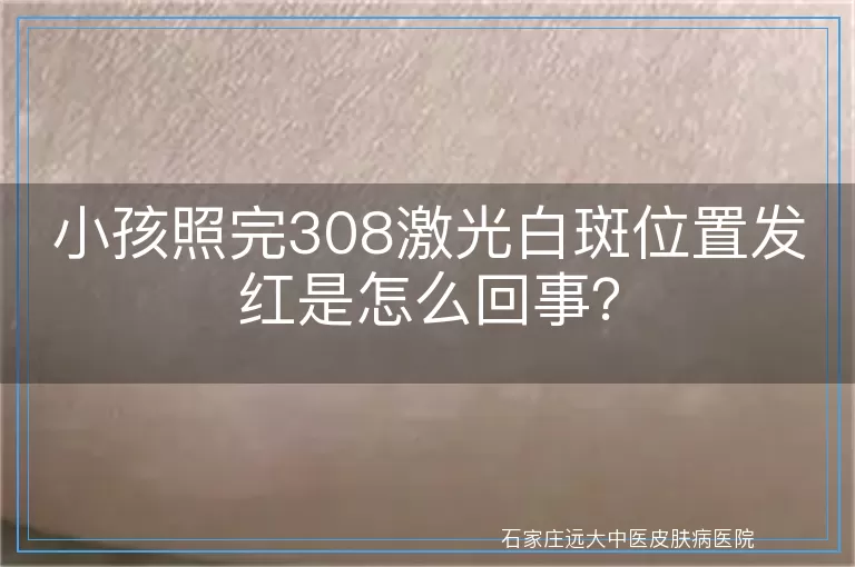 小孩照完308激光白斑位置发红是怎么回事？