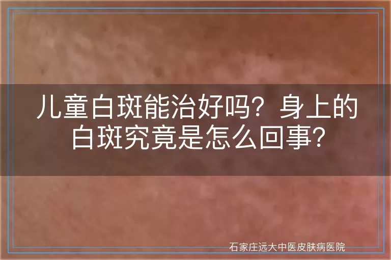 儿童白斑能治好吗？身上的白斑究竟是怎么回事？