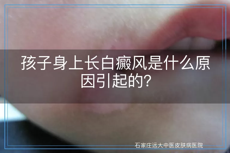 孩子身上长白癜风是什么原因引起的？