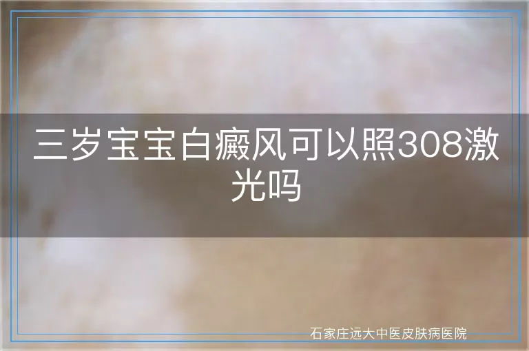 三岁宝宝白癜风可以照308激光吗