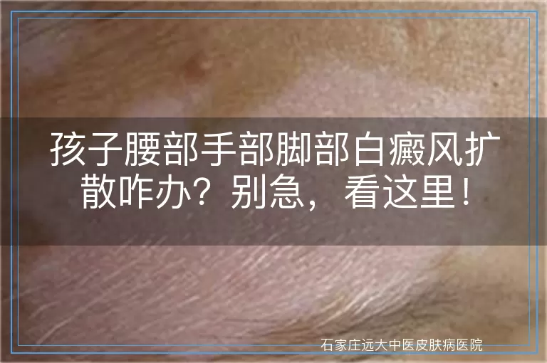 孩子腰部手部脚部白癜风扩散咋办？别急，看这里！