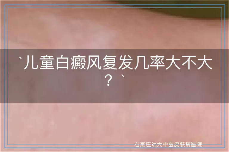 儿童白癜风复发几率大不大？