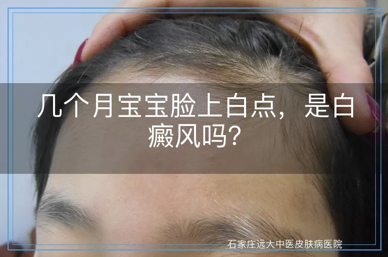 几个月宝宝脸上白点，是白癜风吗？