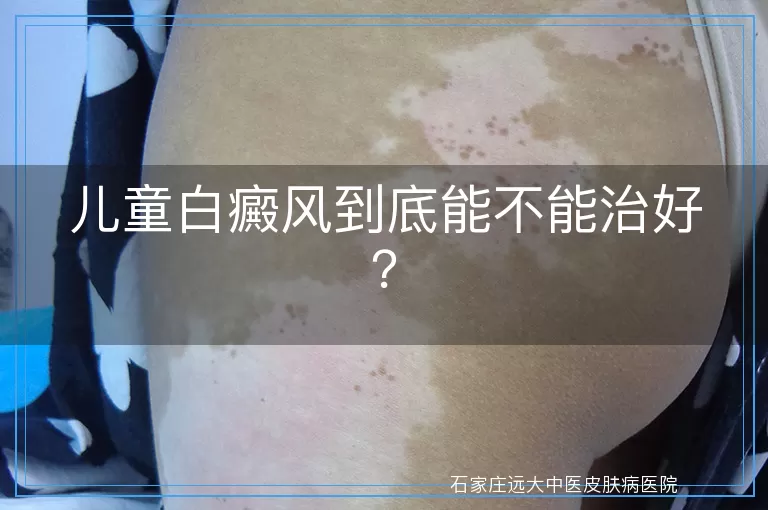 儿童白癜风到底能不能治好？