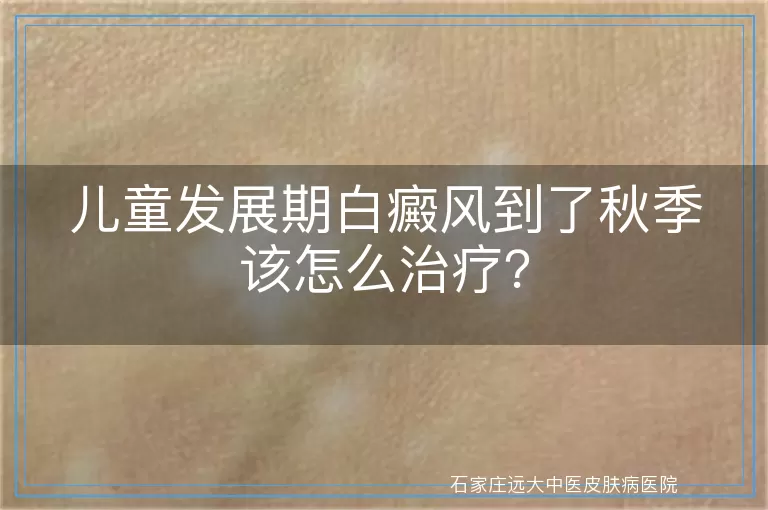 儿童发展期白癜风到了秋季该怎么治疗？